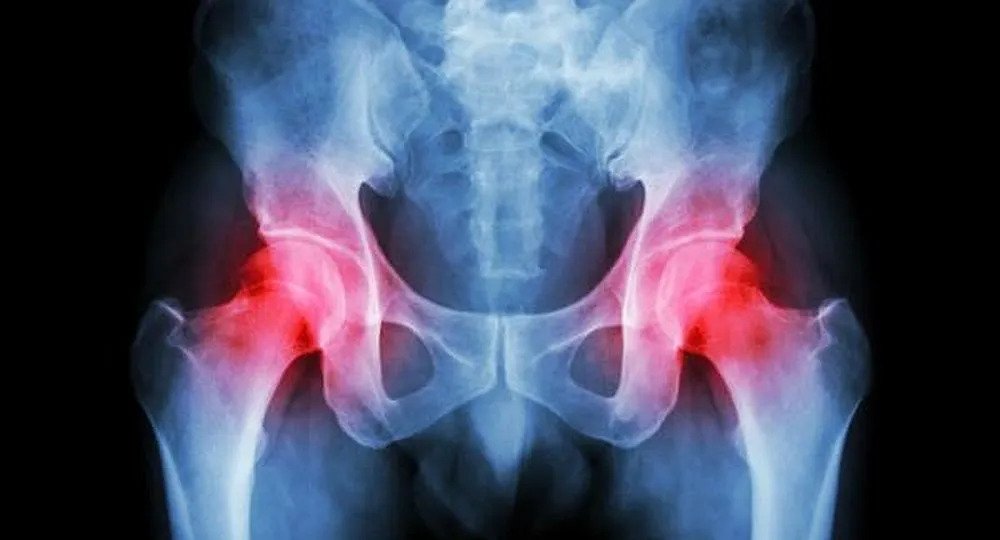 SESSİZ TEHLİKE “KALÇA KEMİĞİ ÇÜRÜMESİ NEDİR?