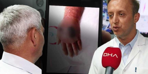 Elini ısıran hırsız yüzünden kolu kesilecekti! Doktorlar şaşkın: Bizim için de ilk oldu, literatüre girecek